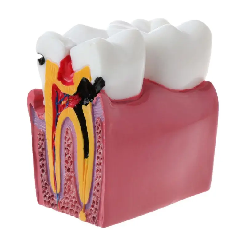 6-szor Fogszuvasodás összehasonlítás Anatómiai fogak modellje fogászati anatómiai laboratóriumi oktatáshoz Kutató eszköz tanulmányozása - 0