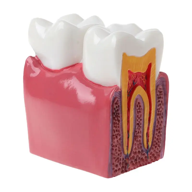6-szor Fogszuvasodás összehasonlítás Anatómiai fogak modellje fogászati anatómiai laboratóriumi oktatáshoz Kutató eszköz tanulmányozása - 1