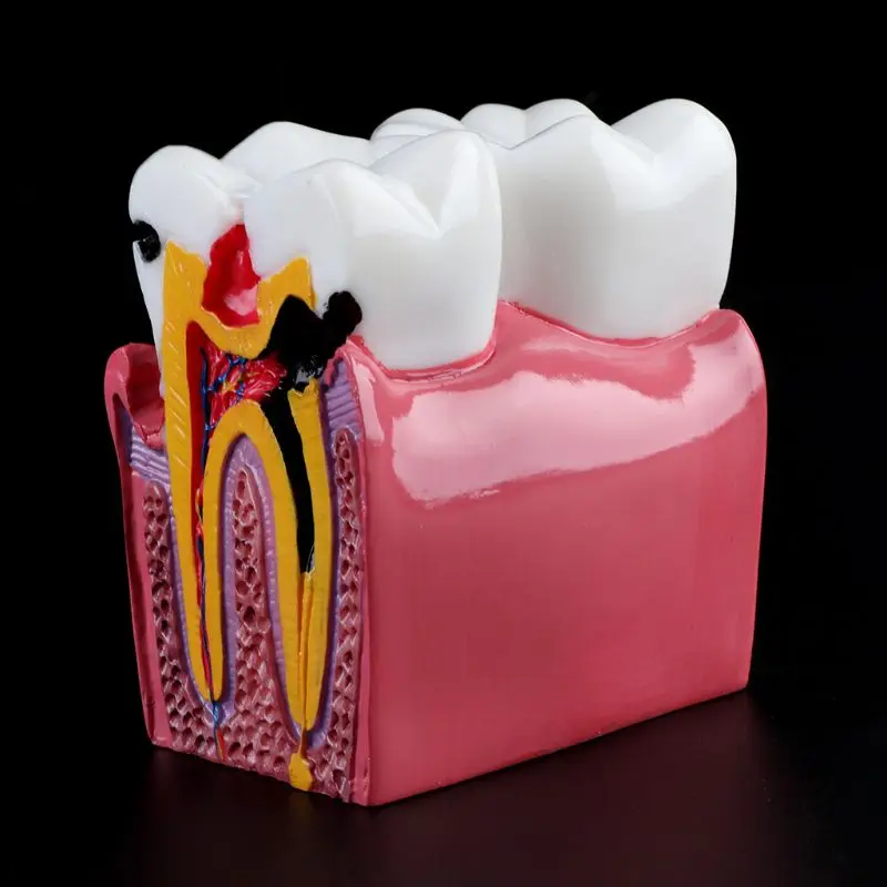 6-szor Fogszuvasodás összehasonlítás Anatómiai fogak modellje fogászati anatómiai laboratóriumi oktatáshoz Kutató eszköz tanulmányozása - 2
