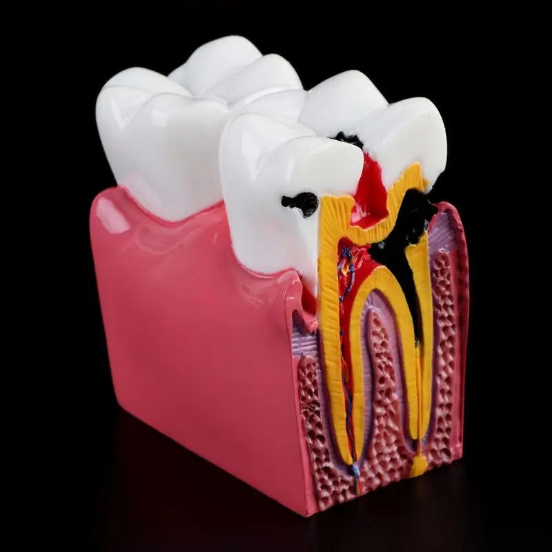 6-szor Fogszuvasodás összehasonlítás Anatómiai fogak modellje fogászati anatómiai laboratóriumi oktatáshoz Kutató eszköz tanulmányozása - 3