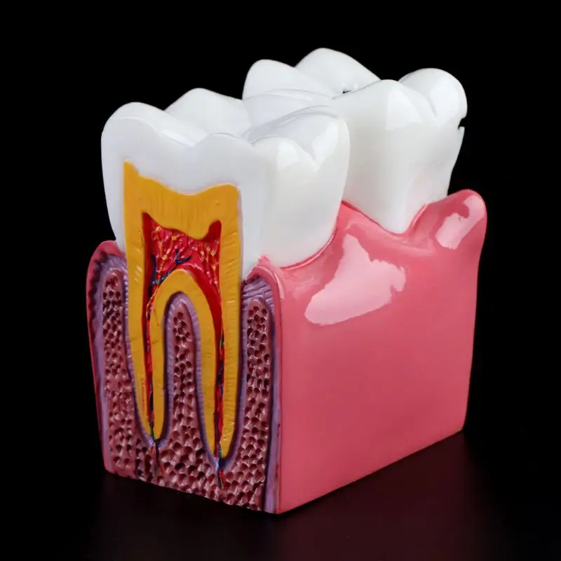 6-szor Fogszuvasodás összehasonlítás Anatómiai fogak modellje fogászati anatómiai laboratóriumi oktatáshoz Kutató eszköz tanulmányozása - 4