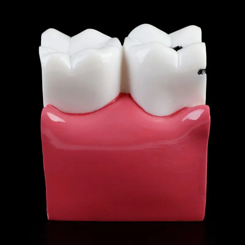 6-szor Fogszuvasodás összehasonlítás Anatómiai fogak modellje fogászati anatómiai laboratóriumi oktatáshoz Kutató eszköz tanulmányozása - 5
