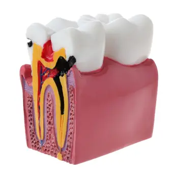 6-szor Fogszuvasodás összehasonlítás Anatómiai fogak modellje fogászati anatómiai laboratóriumi oktatáshoz Kutató eszköz tanulmányozása
